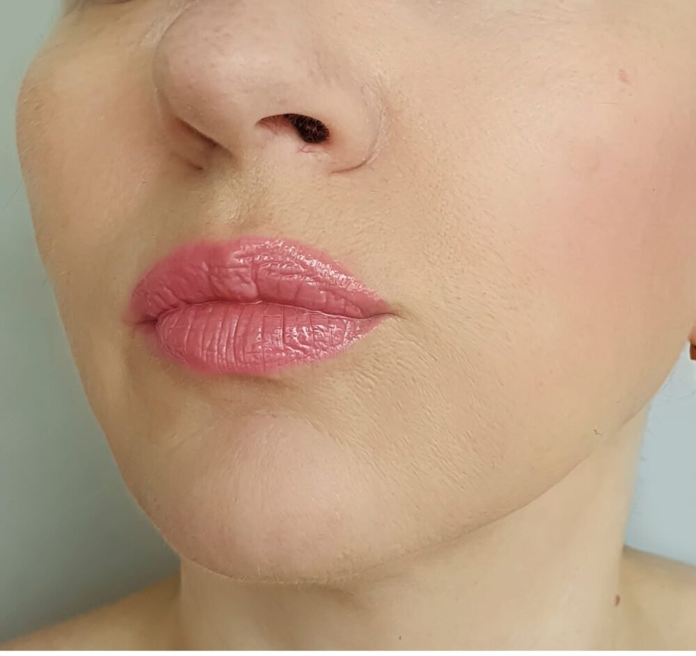 results after face lift threads